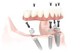 dental implant denture